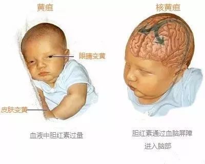家有“小黄人”宝宝可不是闹着玩儿的！分清新生儿黄疸很重要