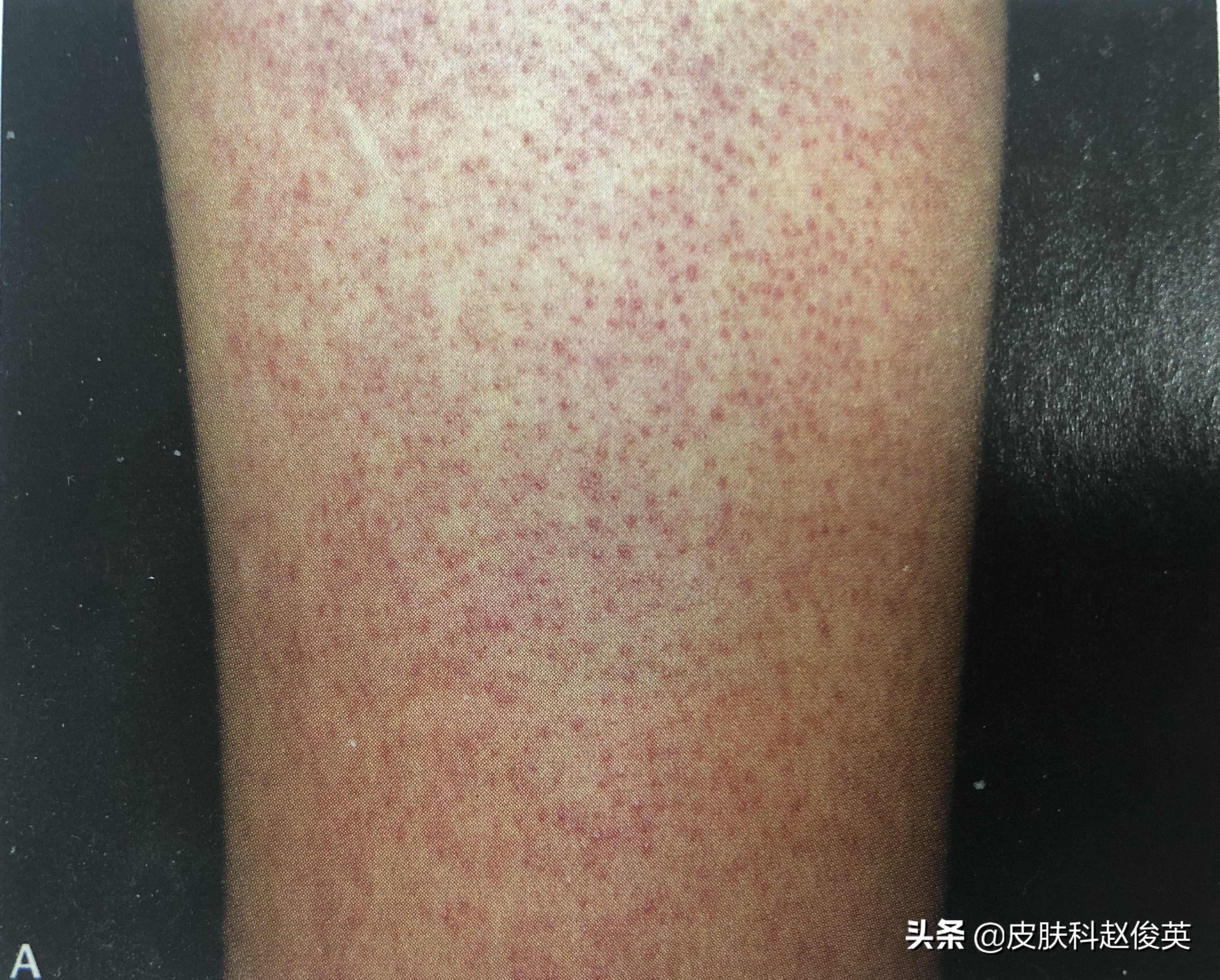 鸡皮肤太丑怎么办图片,鸡皮肤如何改善最有效