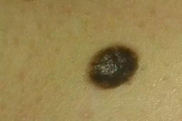 出现痣警惕肝脏病变,肝痣是肝脏发出的求救信号