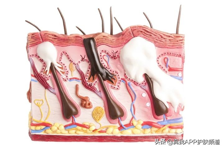 为什么痘痘消失后毛孔粗大了,长了痘痘怎么使它快速瘪下去