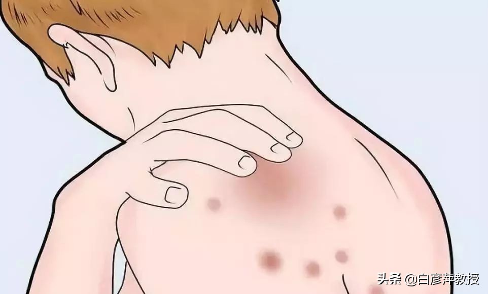 湿疹是什么原因造成的湿疹怎么治,肛周湿疹其他部位也有湿疹怎么办