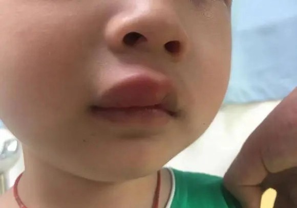 两岁半半夜嘴巴肿了,小孩子嘴肿了吃什么