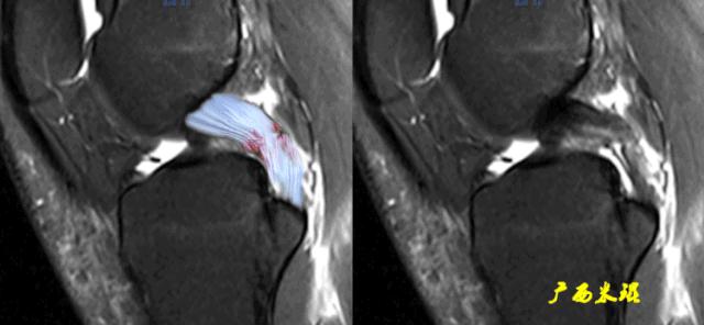 交叉韧带损伤的mr表现,后交叉韧带损伤的诊断实验