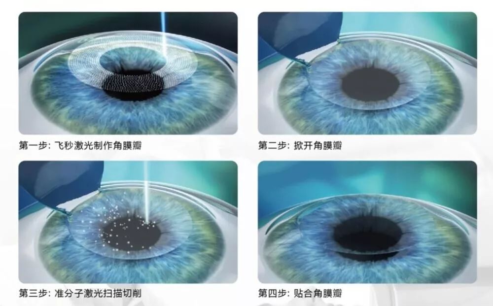 800度近视也能矫正吗,15岁近视800度增长得很快怎么办