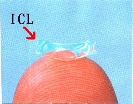 800度近视也能矫正吗,15岁近视800度增长得很快怎么办