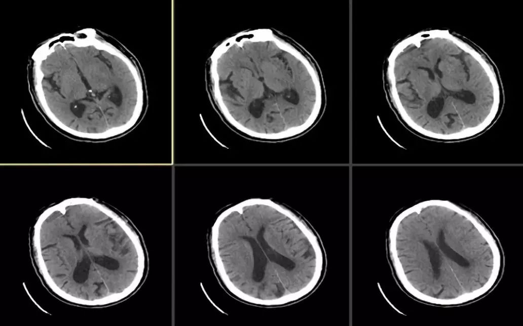 颈动脉狭窄介入治疗的后遗症,颈动脉闭塞介入手术是局麻吗