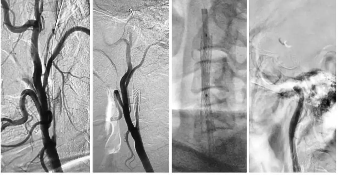 颈动脉狭窄介入治疗的后遗症,颈动脉闭塞介入手术是局麻吗