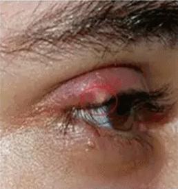 一粒小小的“针眼”，4岁女童差点丧命！就因为奶奶这个举动……