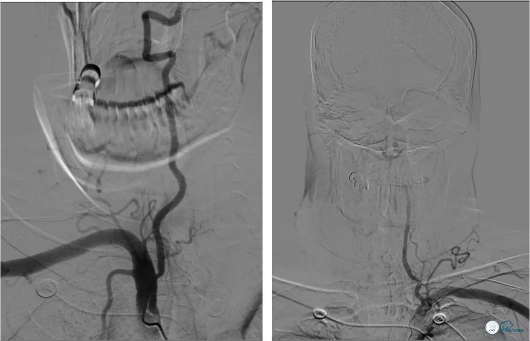 椎动脉狭窄介入手术病例汇报,基底动脉狭窄70%的介入治疗
