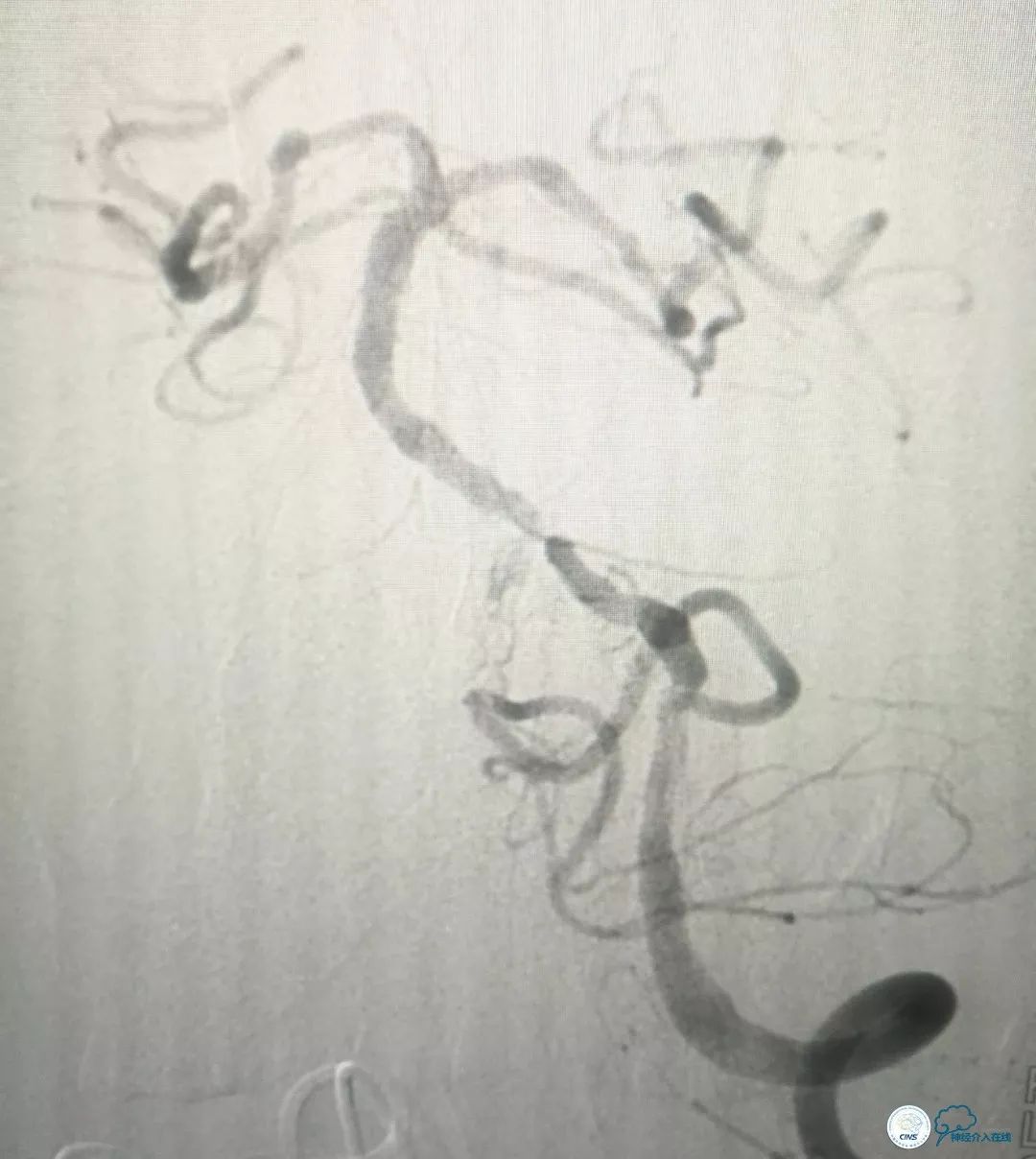 椎动脉狭窄介入手术病例汇报,基底动脉狭窄70%的介入治疗