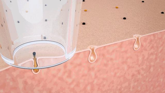 草莓鼻救星怎么治疗,草莓鼻去黑头神器视频