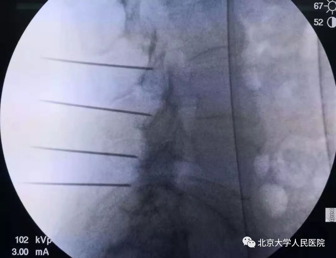 科普胸痛千万不要大意,医生科普疼痛科