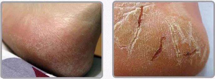 治脚气的抗真菌偏方,角化型脚气干裂最好的药