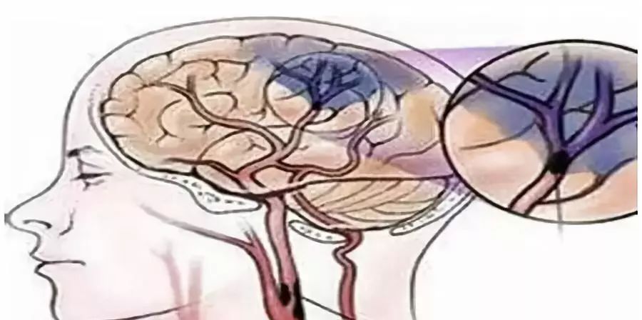 脑血栓跟肺有关系吗,脑血栓每天走多远