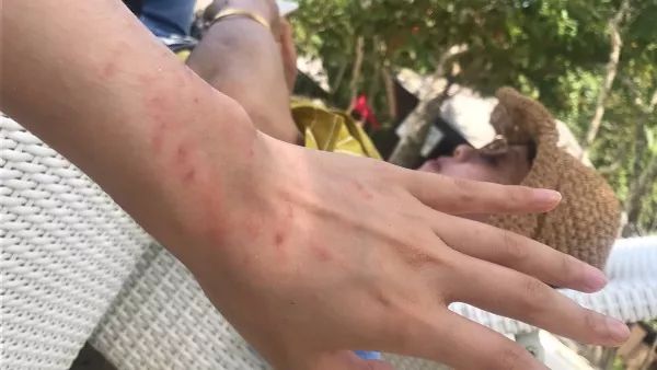 被海葵蜇了排毒要多久,戴着手套会被海葵蜇到吗