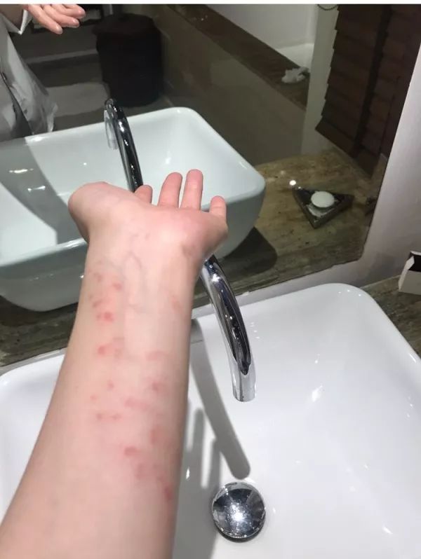 被海葵蜇了排毒要多久,戴着手套会被海葵蜇到吗