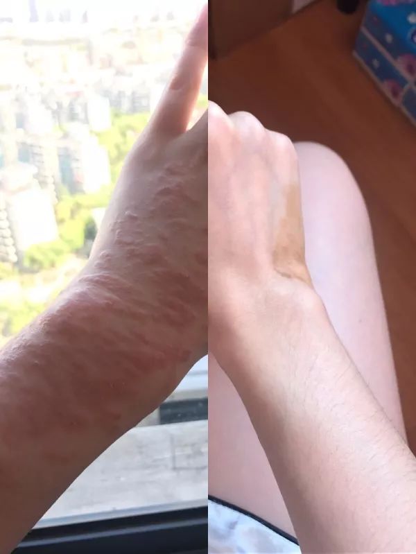 被海葵蜇了排毒要多久,戴着手套会被海葵蜇到吗