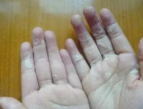 这个季节手脚脱皮咋治,还在为手脚脱皮烦恼吗