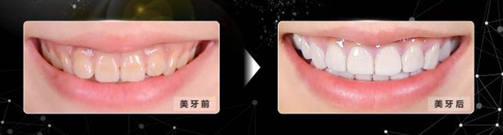 国家牙齿矫正种牙新政策,能全口种植牙齿一般需要多少钱