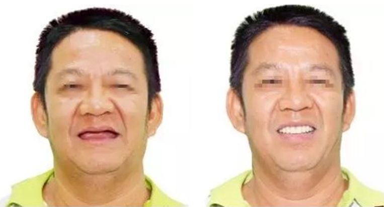 国家牙齿矫正种牙新政策,能全口种植牙齿一般需要多少钱