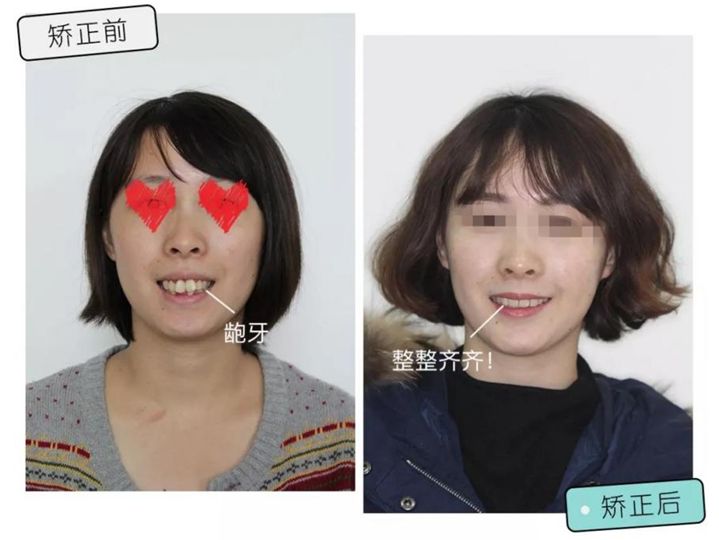 国家牙齿矫正种牙新政策,能全口种植牙齿一般需要多少钱