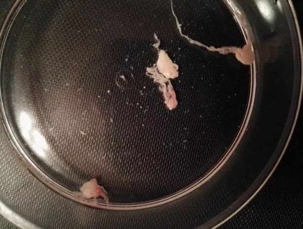 美国治肺癌能治愈吗,我在美国治肺癌