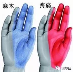 「警惕」手指麻痛，谨慎是腕管综合征！佛中医腕管镜微创治顽疾