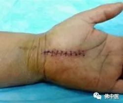 「警惕」手指麻痛，谨慎是腕管综合征！佛中医腕管镜微创治顽疾