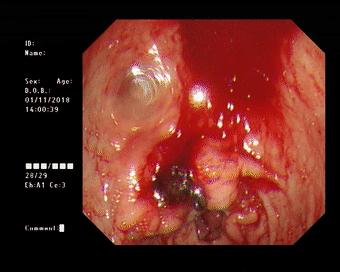 健康出现这些症状谨慎胃病来袭,健康科普胃溃疡反复发作会癌变吗