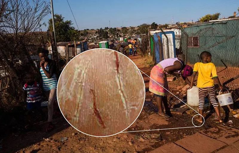 爸妈的手脚布满了老茧,手足干裂是什么前兆