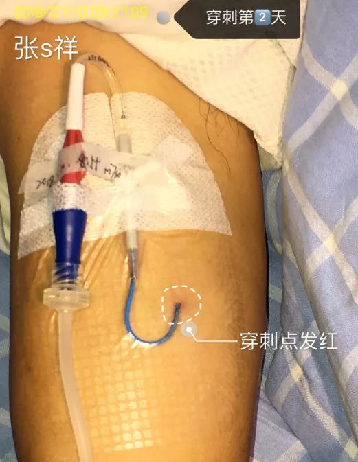 picc穿刺处渗血的预防和处理,picc穿刺部位渗血图片
