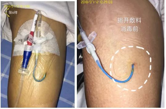 picc穿刺处渗血的预防和处理,picc穿刺部位渗血图片