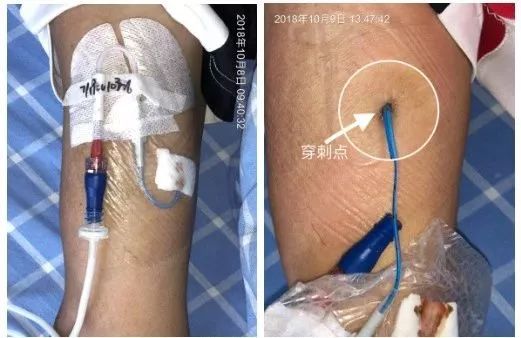 picc穿刺处渗血的预防和处理,picc穿刺部位渗血图片
