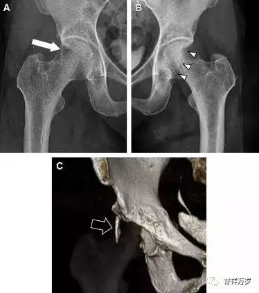 肩关节脱位易漏诊的骨折,放射科容易漏诊的骨折