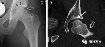 肩关节脱位易漏诊的骨折,放射科容易漏诊的骨折