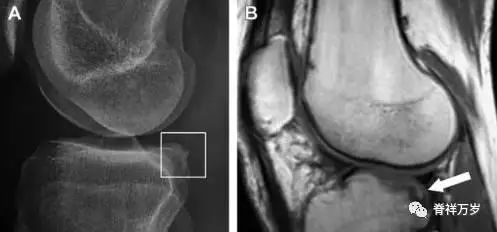 肩关节脱位易漏诊的骨折,放射科容易漏诊的骨折