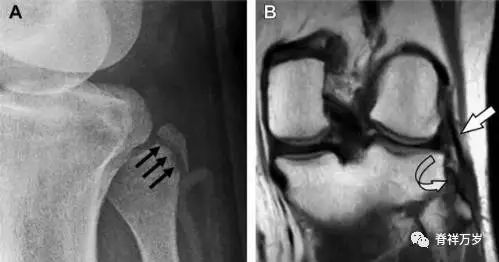 肩关节脱位易漏诊的骨折,放射科容易漏诊的骨折