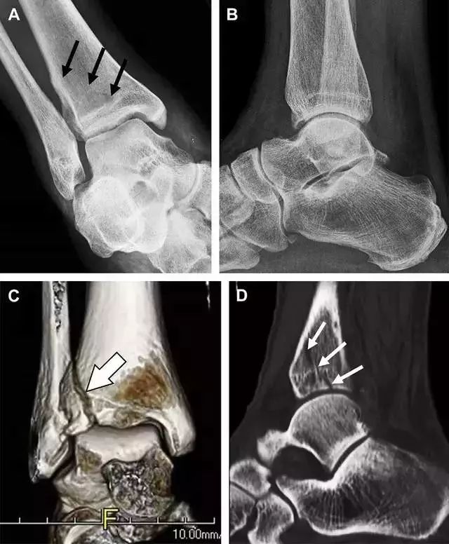 肩关节脱位易漏诊的骨折,放射科容易漏诊的骨折