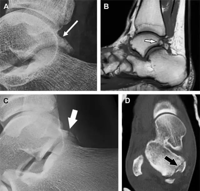 肩关节脱位易漏诊的骨折,放射科容易漏诊的骨折
