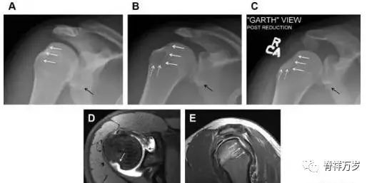 肩关节脱位易漏诊的骨折,放射科容易漏诊的骨折