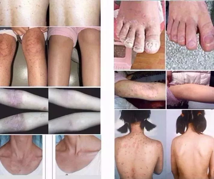 泰国治癣的药膏排行榜,泰国治疗皮肤癣的药膏