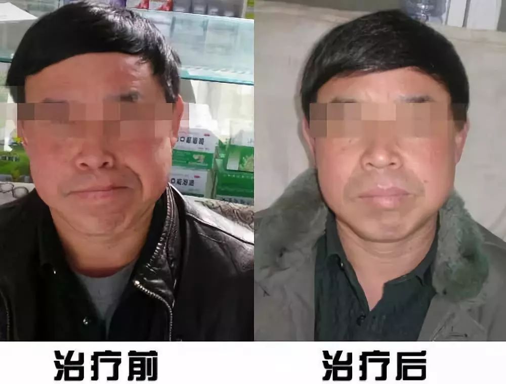 康复科治疗面瘫效果怎么样,面瘫康复训练评分