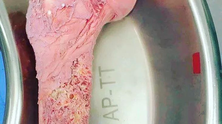 刮骨疗毒原视频,骨外尤文氏瘤治疗成功案例