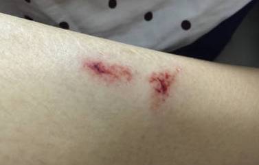 比创可贴好用,最好用的液体创可贴