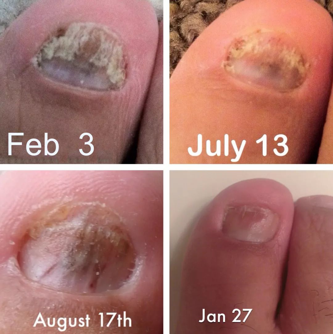 灰指甲的治愈之路你值得拥有,10年顽固灰指甲久治不愈