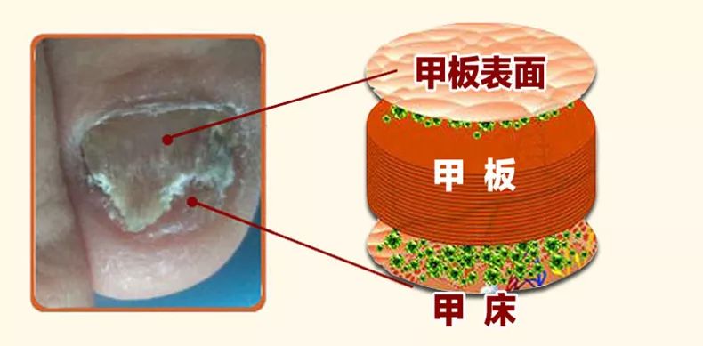 灰指甲的治愈之路你值得拥有,10年顽固灰指甲久治不愈