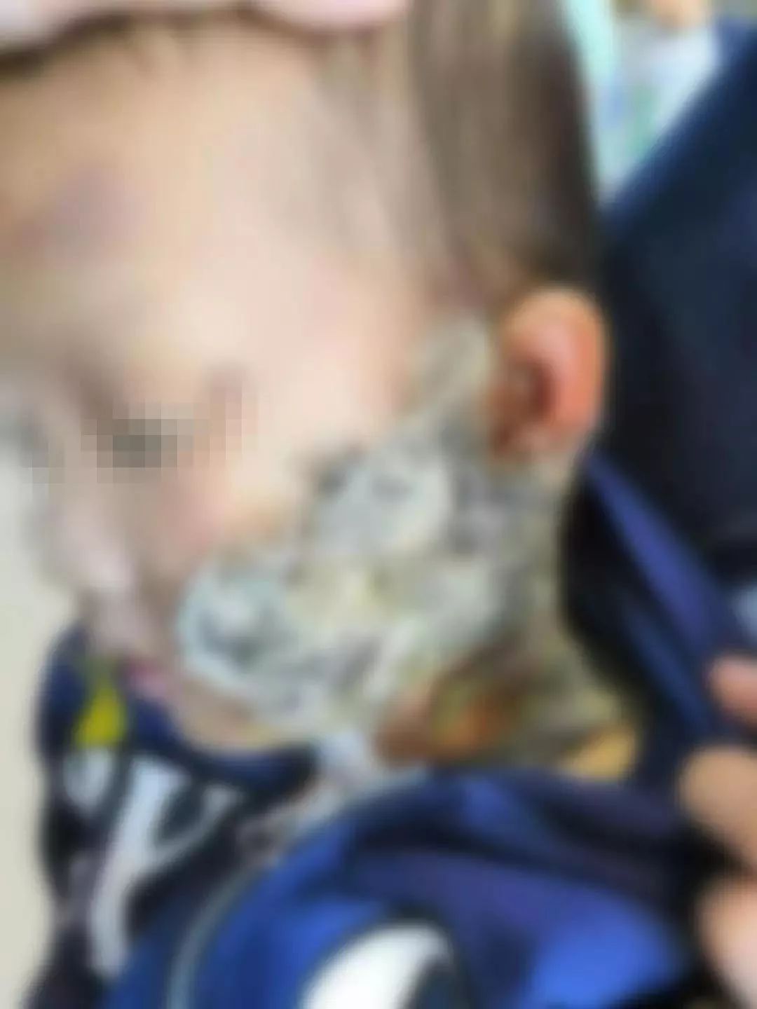 小孩烫伤脸上粘猫毛,孩子烫伤用猫毛敷脸