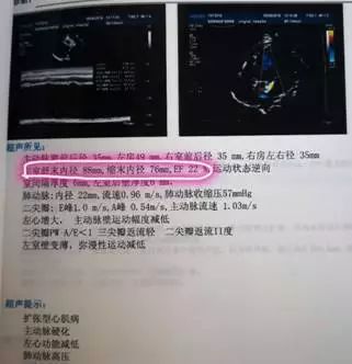 心肌缺血引起心衰能治愈吗,根治心肌缺血的中成药心可舒