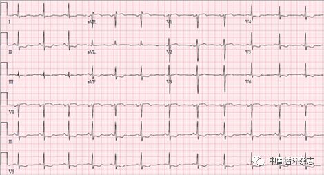JAMA病例：年轻产妇胸痛，广泛ST段压低，心肌酶升高