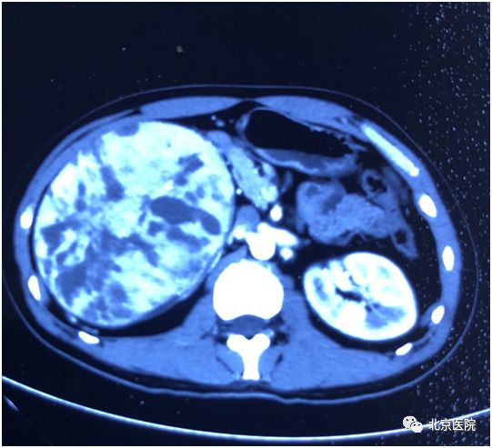 肿瘤肾癌微创手术费用,医大二院肾癌微创手术
